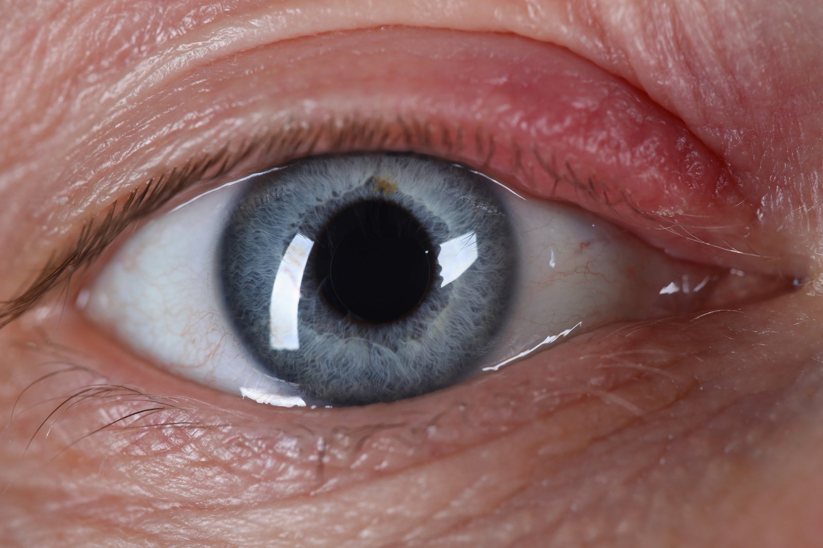 pole-ophtalmologie-colombes-la-defense photo d'un oeil présentant une inflammation de la paupière appelée blépharite
