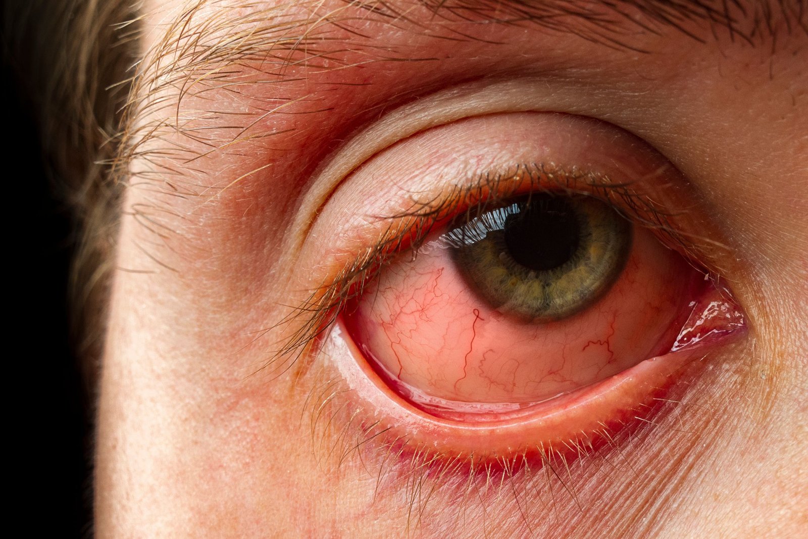 pole-ophtalmologie-colombes-la-defense photo d'un oeil présentant un ectropion avant une chirurgie de la paupière