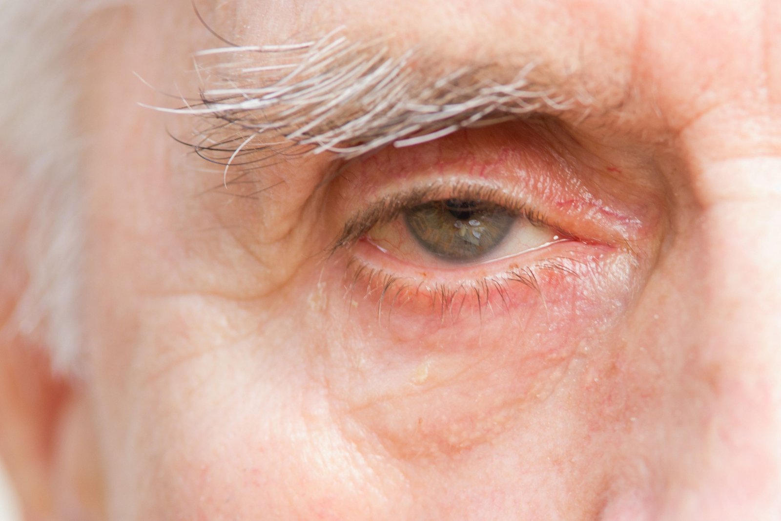 pole-ophtalmologie-colombes-la-defense photo d'un homme âgé présentant un ptosis