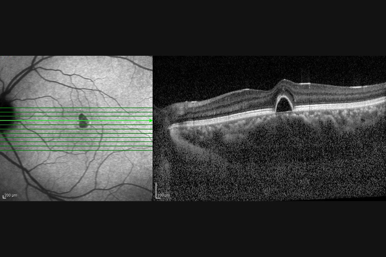choriretinopathie-colombes imagerie ophtalmologique montrant une choriorétinopathie séreuse centrale