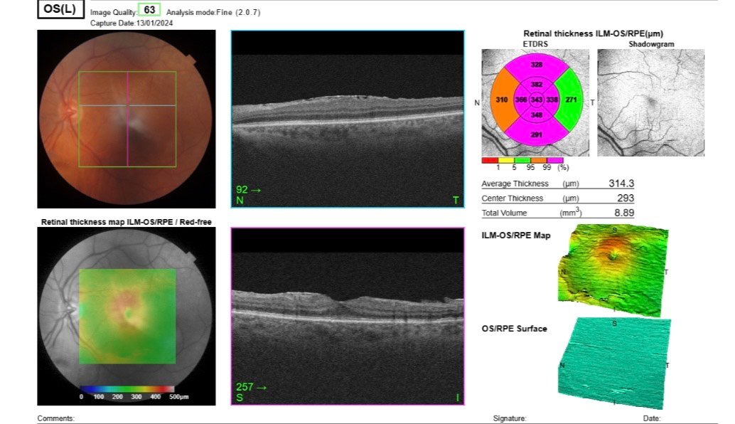 pole-ophtalmologie-colombes-la-defense Planche de résultats d'examen ophtalmologique avant une chirurgie de la membrane épimaculaire