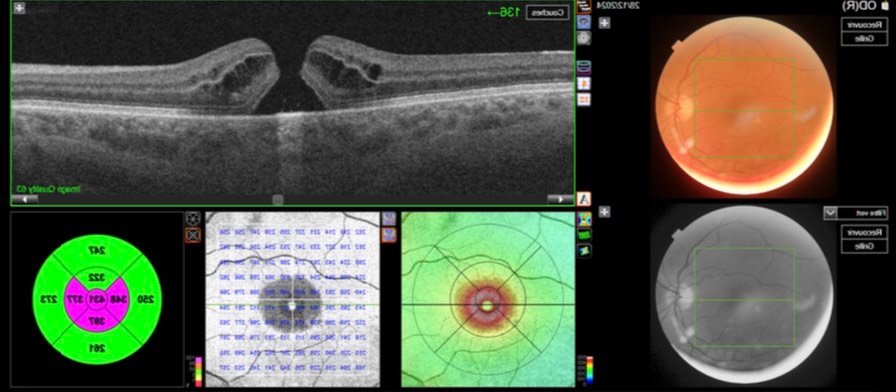 pole-ophtalmologie-colombes-la-defense Planche de résultats d'examen ophtalmologique avant une chirurgie du trou maculaire