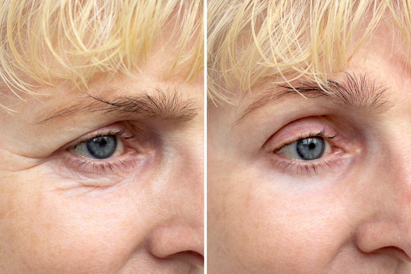 pole-ophtalmologie-colombes-la-defense photos avant après d'une patiente opérée d'un dermatochalasis