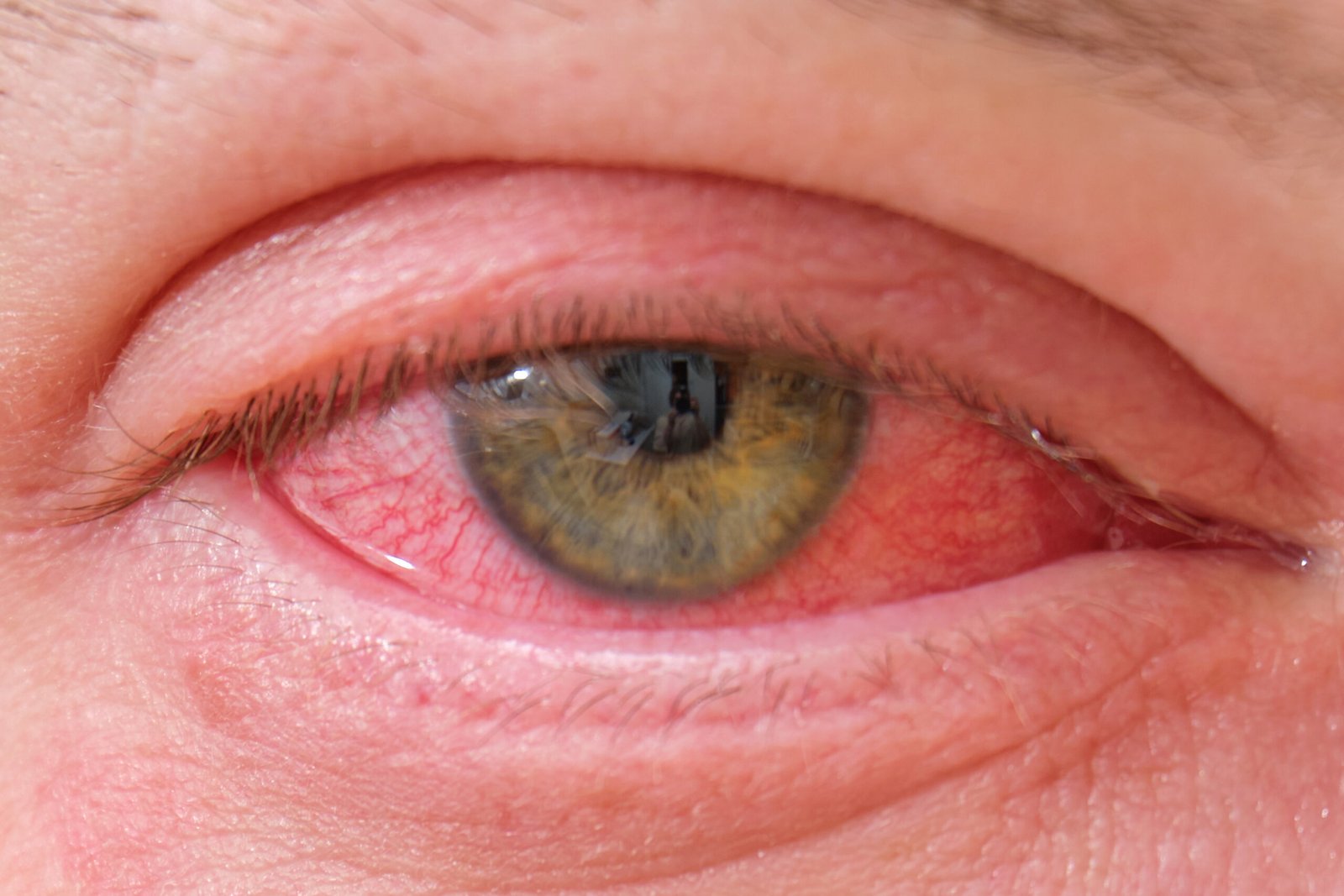 pole-ophtalmologie-colombes-la-defense photo d'un œil présentant une inflammation