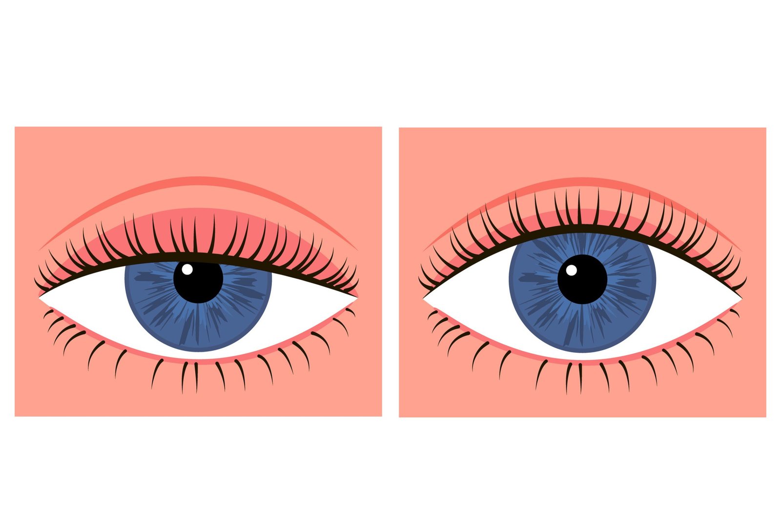 pole-ophtalmologie-colombes-la-defense illustration d'un œil présentant un ptosis