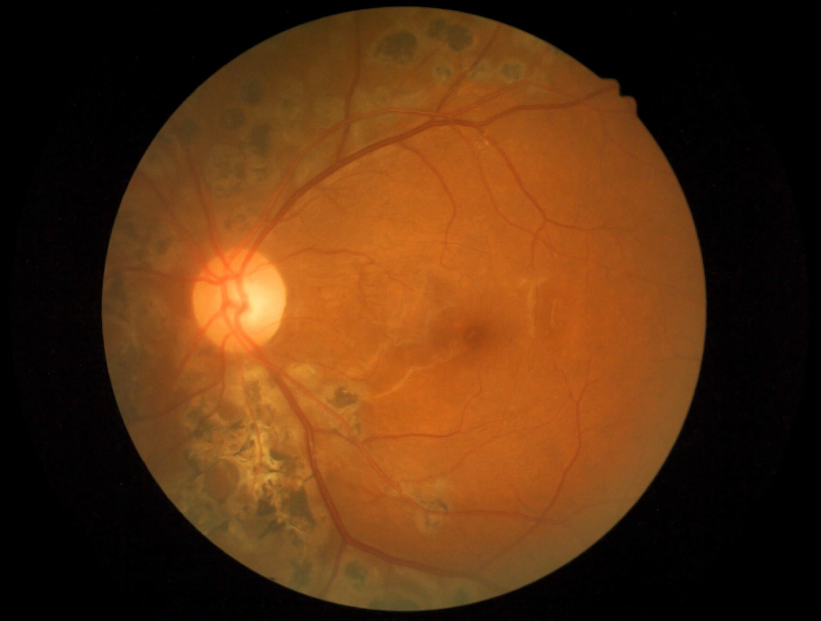 pole-ophtalmologie-colombes-la-defense image d'un fond d'œil montrant une rétinopathie diabétique