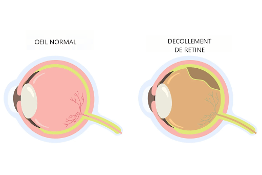 decollement-retine-colombes schéma illustrant le décollement la rétine