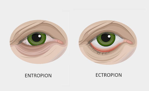 illustration montrant un œil atteint d'entropion et un œil atteint d'ectropion