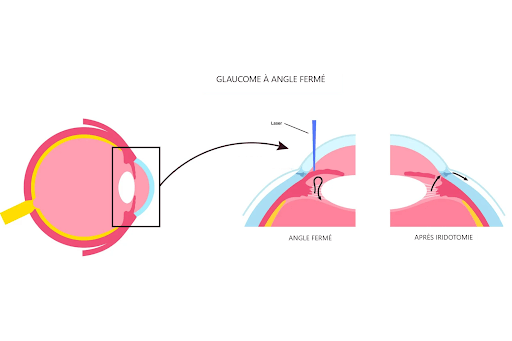 glaucome-angle-ferme-colombes schéma explicatif du glaucome à angle fermé