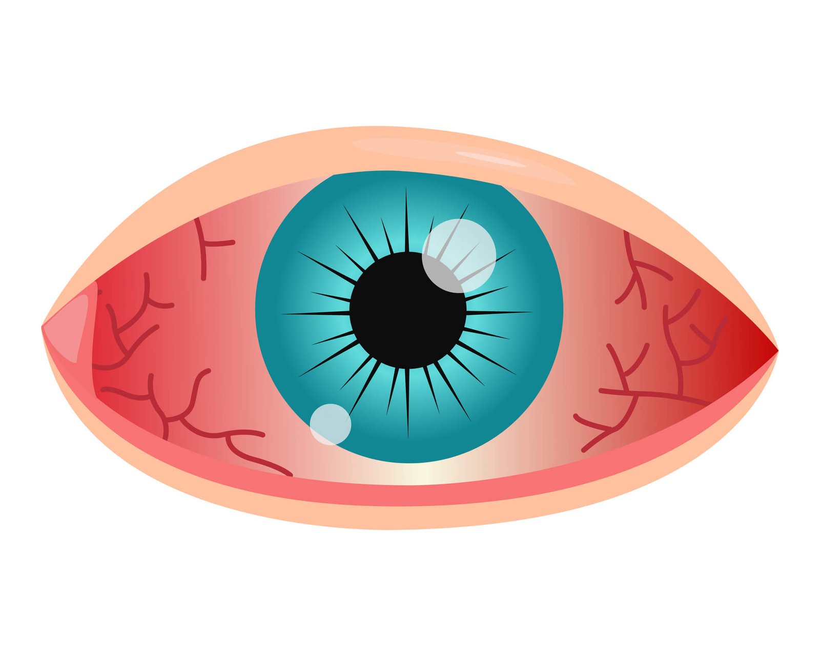 laser-accueil illustration d'oeil rouge évoquant un symptôme d'urgence ophtalmologique